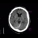 Hemocephalus, subarachonoid hemorrhage, subdural hematoma, brain contusion: CT - Computed tomography